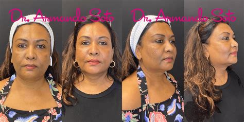 Laser Skin Rejuvenation Before and After Pictures Case 75062 | Orlando ...