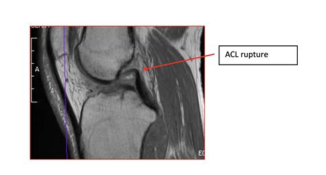 MRI Left Knee Case Study - Greater Waterbury Imaging Center