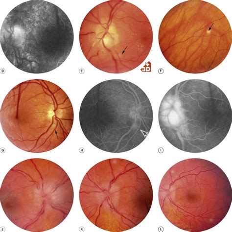 Optic Nerve Diseases that may Masquerade as Macular Diseases | Ento Key