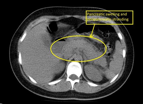 Acute pancreatitis CT - wikidoc