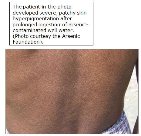 arsenic poisoning symptoms - pictures, photos