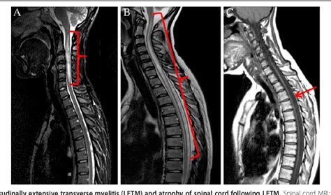 Transverse Myelitis Mri - The Radiology Assistant Myelopathy - Magnetic resonance imaging (mri ...