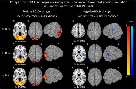 Abnormal response to photic stimulation in Juvenile Myoclonic Epilepsy: An EEG‐fMRI study ...