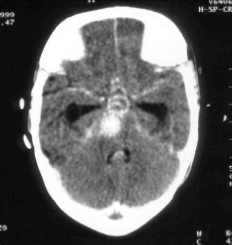 CT scan showng a giant saccular aneurysm possibly emerging from the ...