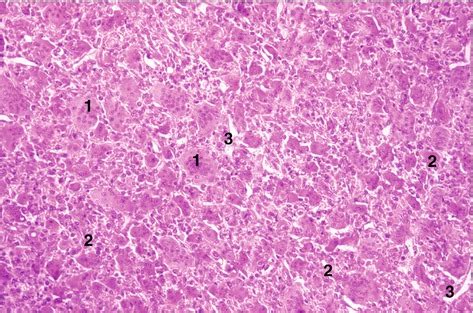 Giant Cell Tumor | Radiology Key