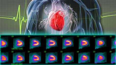 What to Expect: Nuclear Stress Test • MyHeart .net