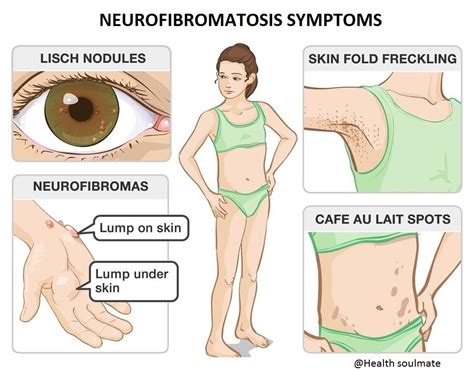 Neurofibromatosis: types, causes, symptoms, diagnosis - Health, Fitness ...