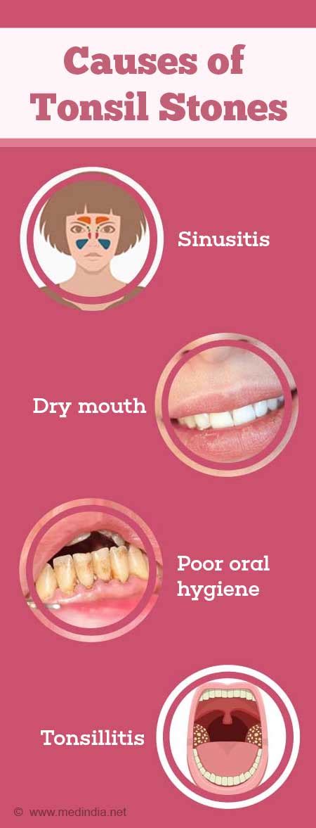 Ideal Info About How To Cure Tonsilloliths - Strangertourist2