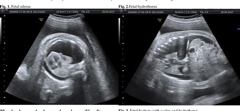 A case of fetal hydrops: prenatal diagnosis and neonatal management | Semantic Scholar