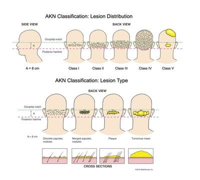 A New Classification System Developed to Improve Treatment for Acne ...