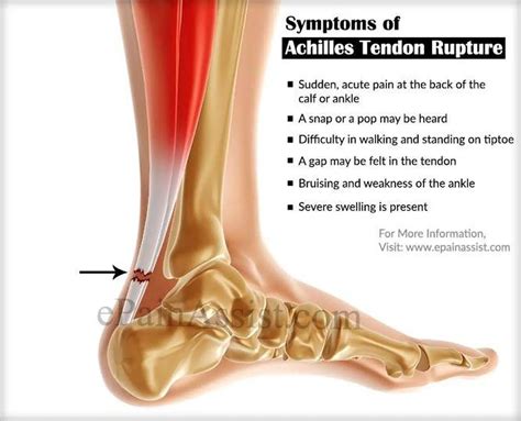 Pictures Of Achilles Tendon