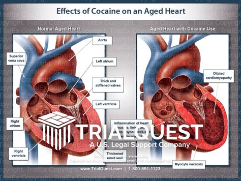 Effects of Cocaine on an Aged Heart - TrialExhibits Inc.