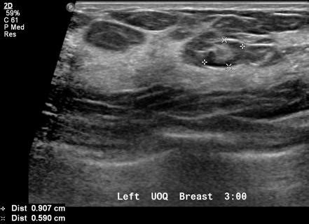 Intramammary lymph nodes | Radiology Reference Article | Radiopaedia.org