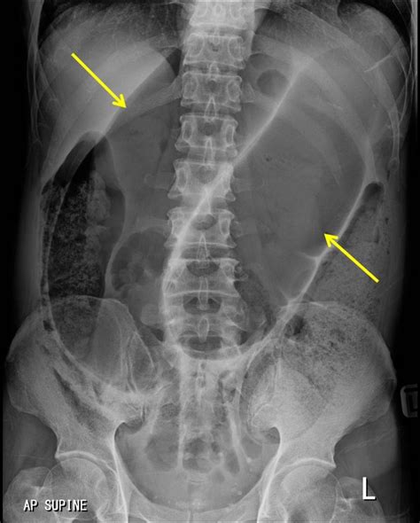 Sigmoid volvulus – Radiology Cases