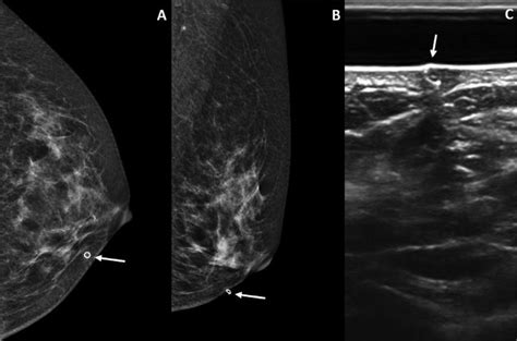 -Craniocaudal (A) and mediolateral oblique (B) mammogram and ultrasound ...