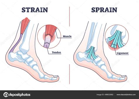 Sprain vs strain anatomical comparison as medical foot injury outline ...