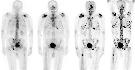 The Detection of Bone Metastases in Patients with High-Risk Prostate Cancer: 99mTc-MDP Planar ...