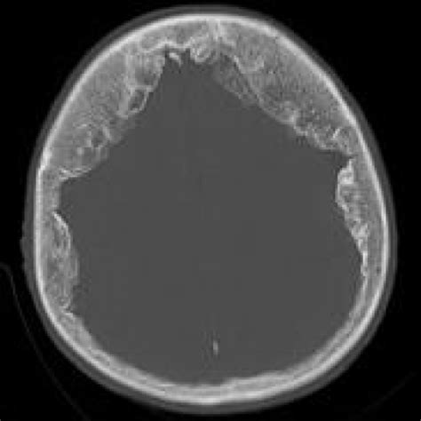 Hyperostosis frontalis interna | Eurorad