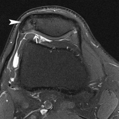 The Painful Bipartite Patella: Imaging Evaluation | Eurorad