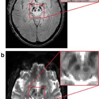 (PDF) Imaging Parkinsonian Pathology in Substantia Nigra with MRI