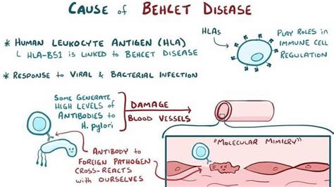 Causes of behcet syndrome - MEDizzy