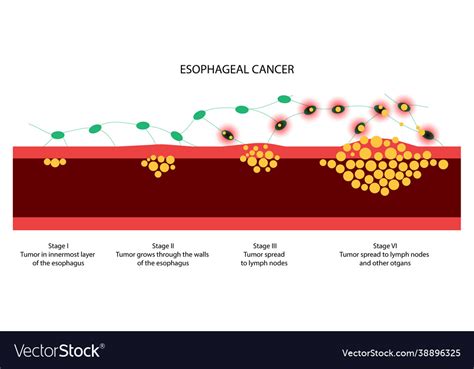 Esophageal cancer stages Royalty Free Vector Image