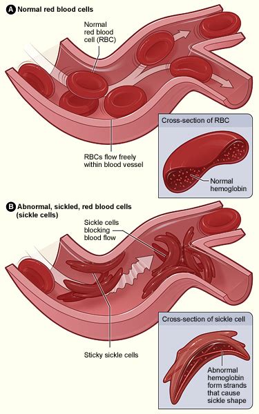 Sickle cell disease - Wikipedia