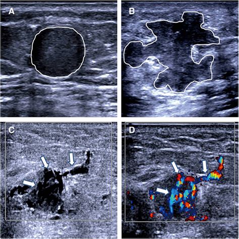 Lymph Node Cancer Ultrasound