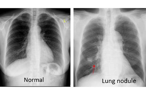 abnormal_xray | Chestmed