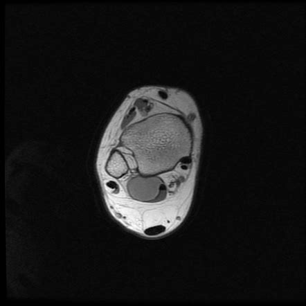 Posterior Ankle Impingement Mri