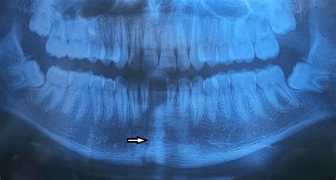 Orthopantomogram showing symphysis fracture of mandible | Download ...