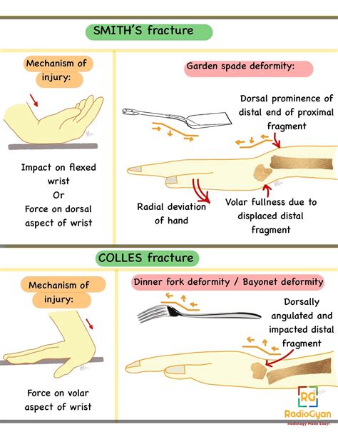 Smith Vs Colles Fracture