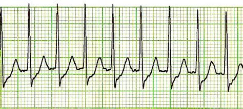 File:SVT Lead II-2.JPG - Wikimedia Commons