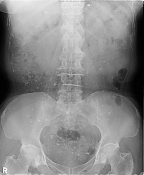 Black Spots On Ct Scan Of Abdomen And Pelvis | Sexiz Pix