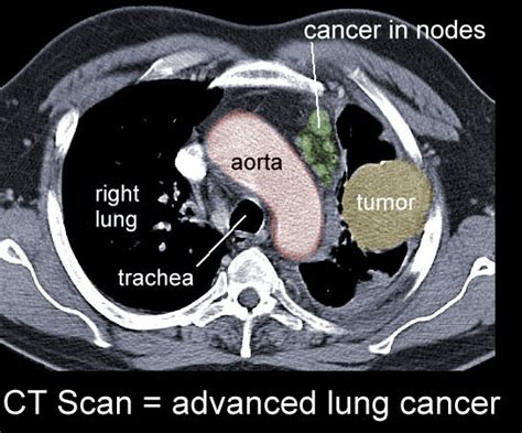 Xrays and CT Scans of Lung Cancer