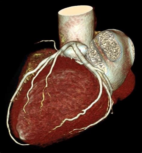 CT Coronary Angiogram - Cardiology Tasmania