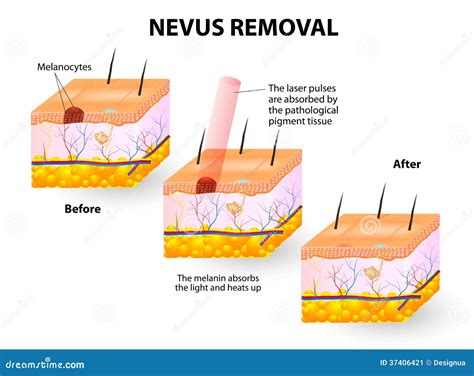 Nevus Removal Stock Image - Image: 37406421