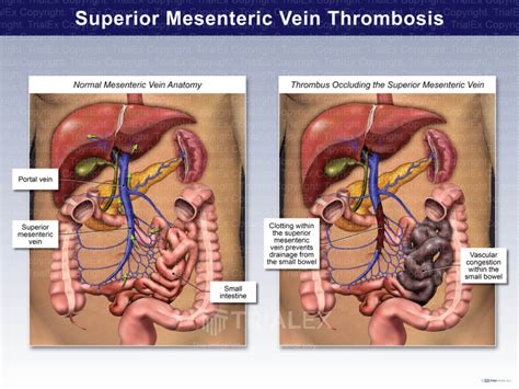 Superior Mesenteric Vein Thrombosis - TrialQuest Inc.