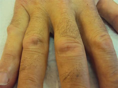 Dupuytren's: Knuckle Pads: Dorsal Dupuytren Nodules