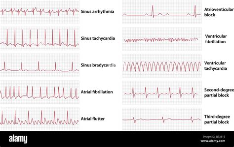 Tachycardie ventriculaire ecg Banque d'images vectorielles - Alamy