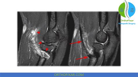 Distal Biceps Tendon Tear | OrthoFixar 2024