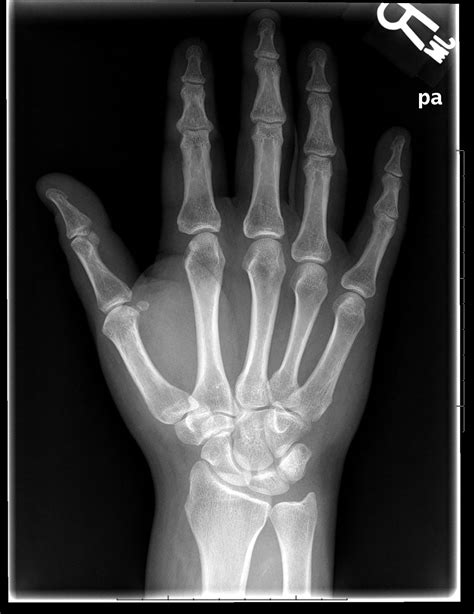 Archive Of Unremarkable Radiological Studies: Right Hand X-Ray - Stepwards