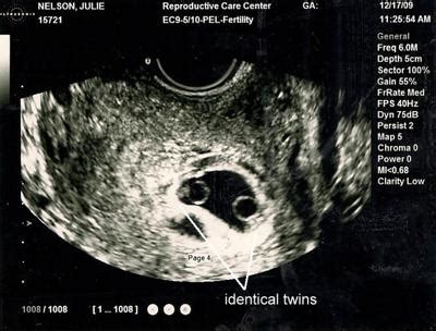 Identical Twins Ultrasound - 7 Weeks 2 Days