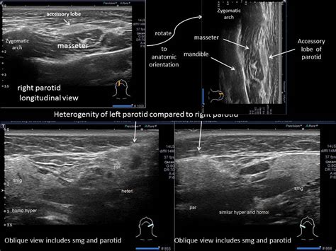 Parotid Gland Duct Ultrasound