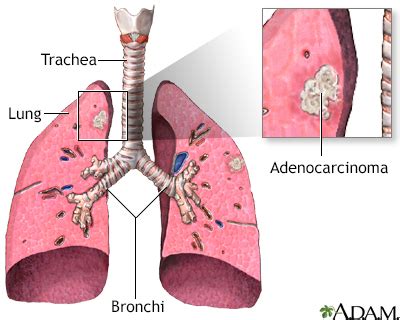 Lung cancer - small cell Information | Mount Sinai - New York