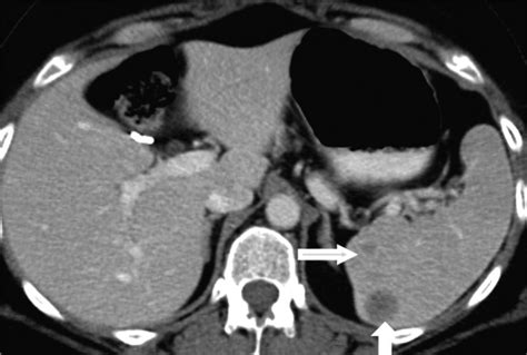 Spleen in haematological malignancies: spectrum of imaging findings. - Abstract - Europe PMC