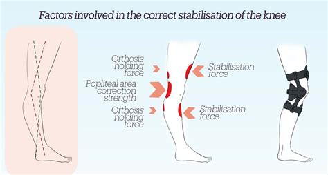 Orthosis for the control of the Genu-Recurvatum D50 – Prim Export