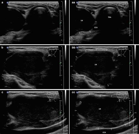 Lymph Nodes Thyroid Ultrasound