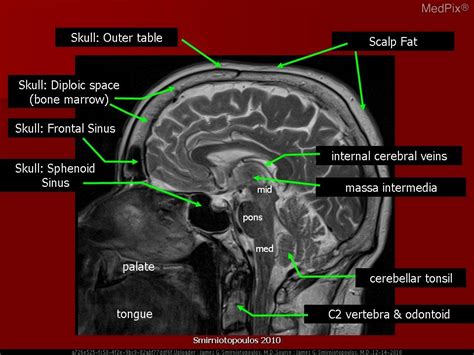 Hippocampus Mri Sagittal