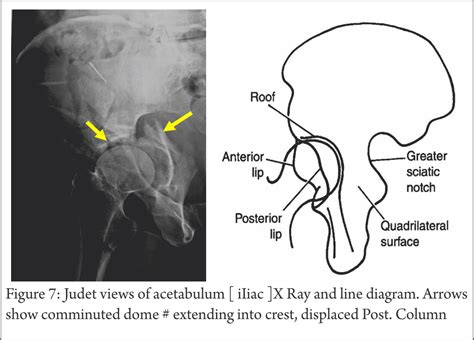 Understanding Clinical Radiology of Fracture Acetabulum - Trauma International